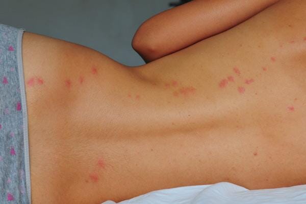 Risques sanitaires liés aux Punaises De Lit