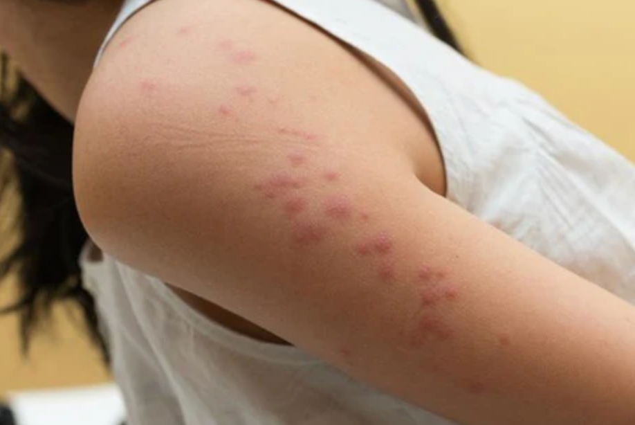 Piqûres de punaises de lit sur un bras : boutons rouges alignés apparus au réveil
