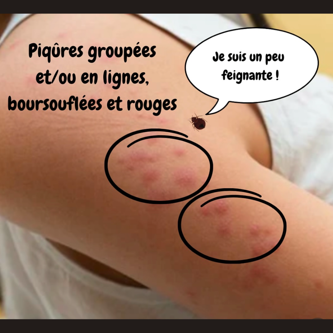 photo qui montre les piqures de punaise de lit sur le bras